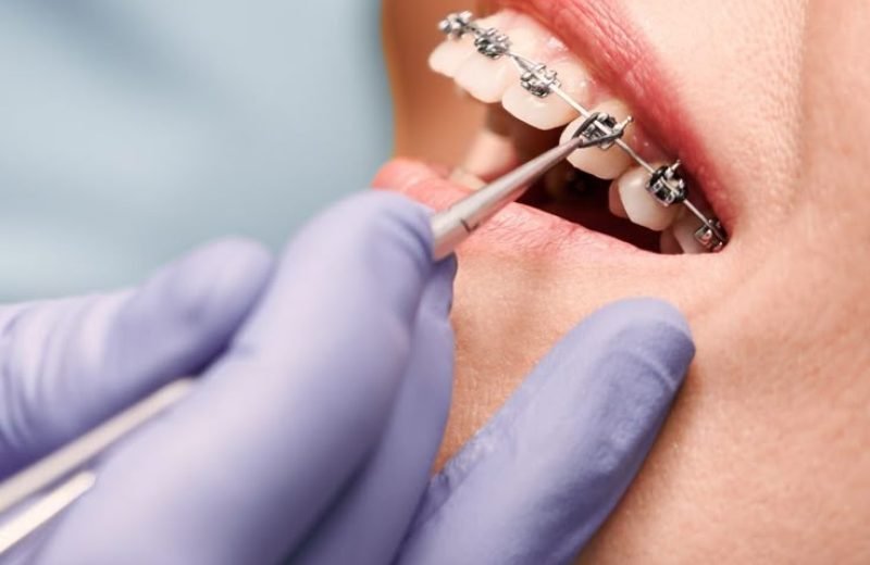 Perfecting Smiles_ Your Guide to Orthodontic Choices in NYC
